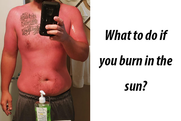 How To Treat Sunburn 9to5buzz 4646